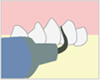 3.歯石・歯垢除去